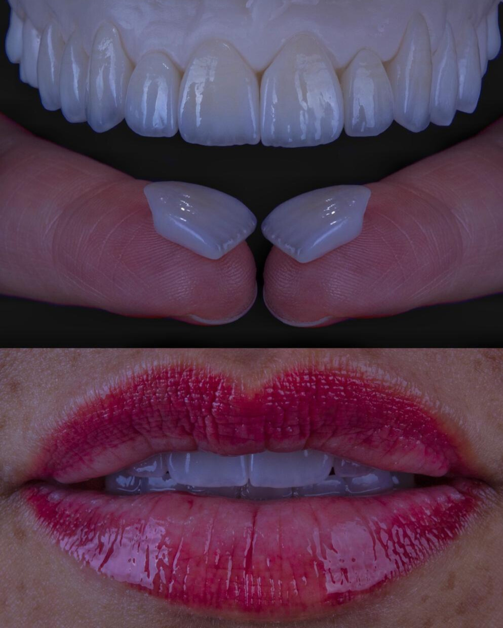 Alinhadores Transparentes